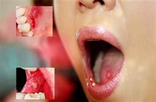 5 cách tự nhiên giúp chữa nhiệt miệng