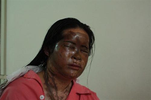 Hai vợ chồng bị tạt axit trong đêm