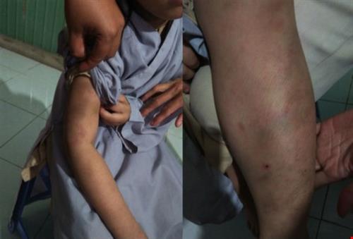 Bé gái bảy tuổi bị đánh bầm tím trong cơ sở tu tại gia