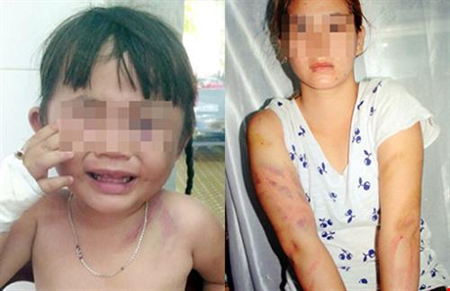 Bé gái ba tuổi bị bạo hành bất tỉnh