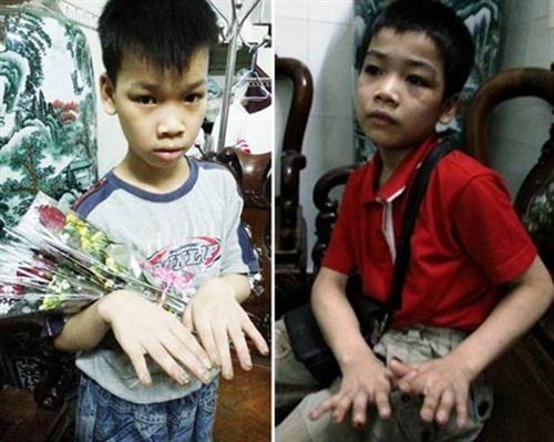 Phẫn nộ việc bốn trẻ em bị hành hạ tàn nhẫn