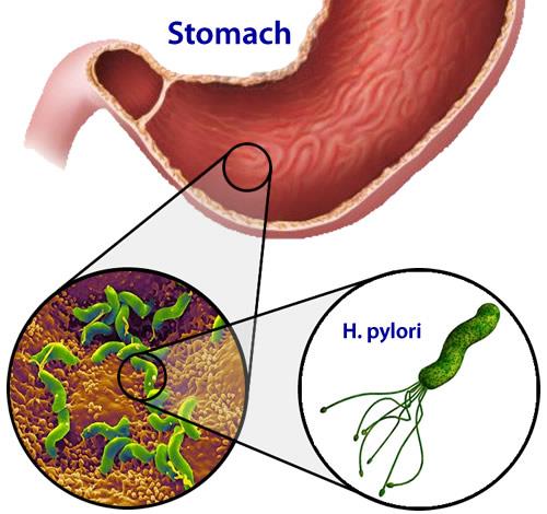 Lợi ích bất ngờ của vi khuẩn dạ dày H.Pylori