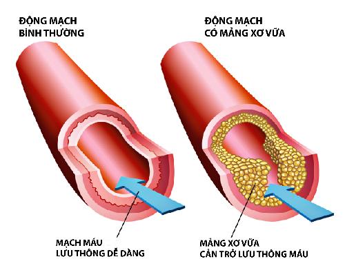 Tư vấn về bệnh rối loạn mỡ máu