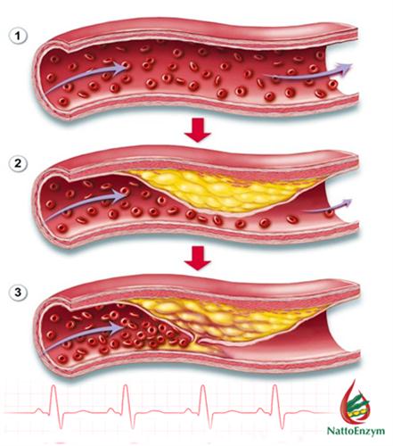  Bệnh mỡ máu là gì? Điều trị như thế nào?