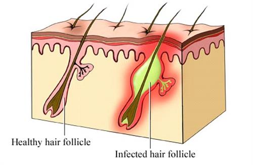 Thuốc trị bệnh viêm nang lông