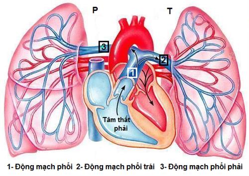 Nhận biết tắc mạch phổi do mỡ