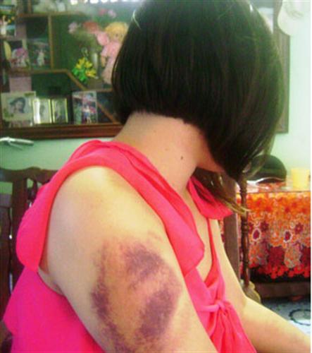 Một nữ sinh tố bị cha hành hung dã man