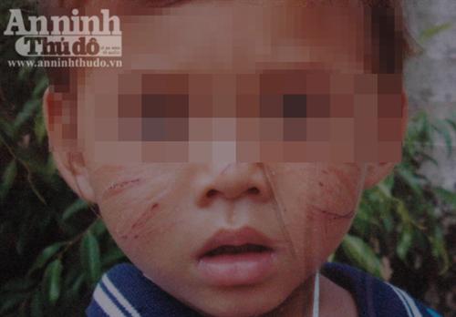 Vừa hận, vừa thương kẻ nhiều lần rạch mặt bé 20 tháng tuổi