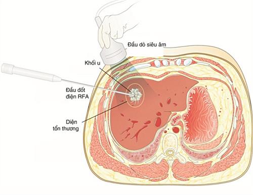 Ung thư gan: Cách phát hiện và phòng bệnh