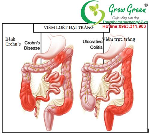 Viêm đại tràng - 1 căn bệnh phổ biến khá nguy hiểm